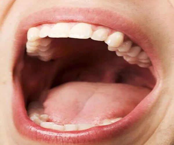 [ID: a closeup of an open, Caucasian person's mouth. Lips, teeth, tongue and the back of the throat are all visible. End]