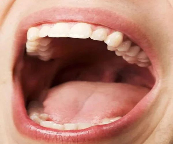 [ID: a closeup of an open, Caucasion person's mouth. Lips, teeth, tongue, and the back of the throat are all visible. End]